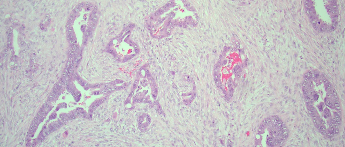 Pancreatic ductal adenocarcinoma