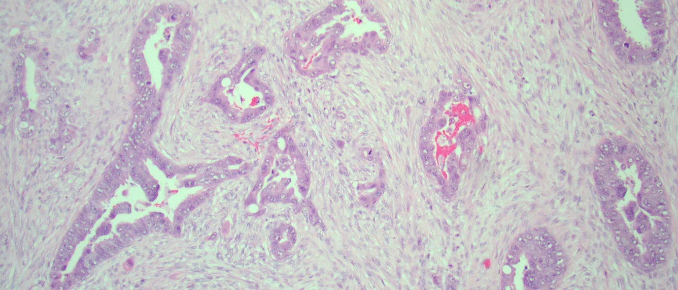 Pancreatic ductal adenocarcinoma